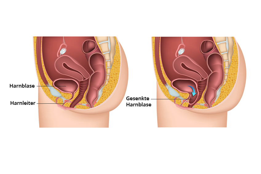 Risiken gebärmuttersenkung operation Gebärmuttersenkung